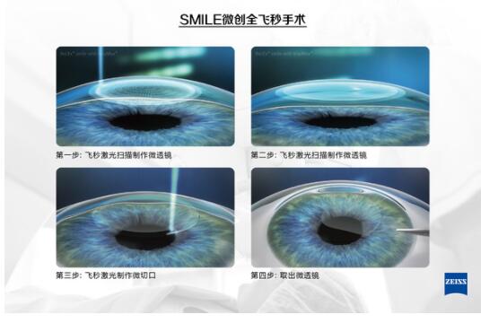 有近視，全飛秒激光手術后視力更好