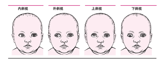 發現孩子是斜眼怎么好