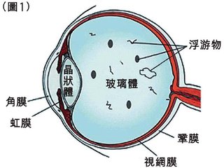 眼前有黑點(diǎn)飄，視物有些變形是什么眼病