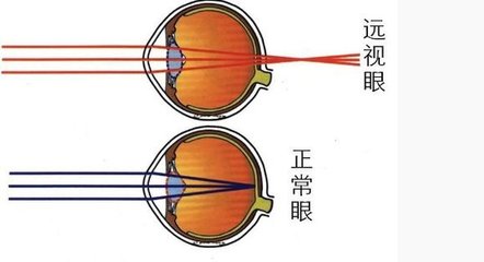 造成遠視眼的病因病理