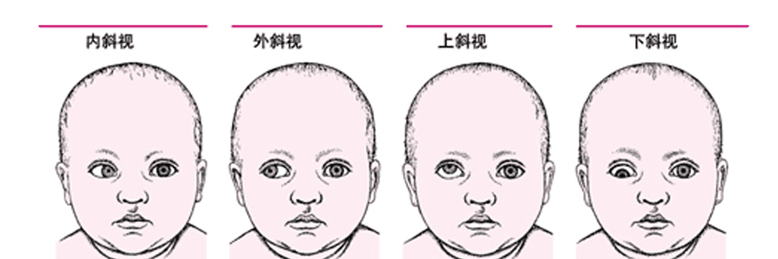 不同斜視不同矯治方法